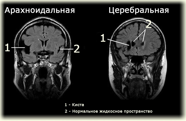  Киста головного мозга у новорожденного