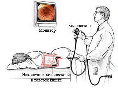 колоноскопия