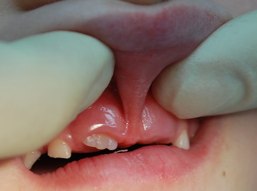 Короткая уздечка верхней губы