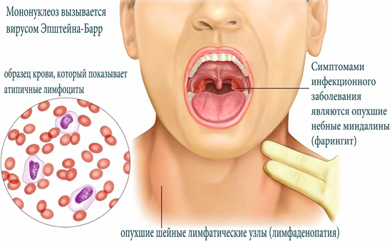 Инфекционный мононуклеоз