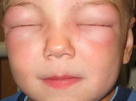 отек Квинке отек Квинке