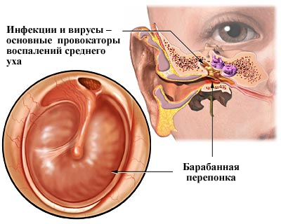 Отит