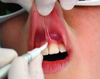 Пластика уздечки