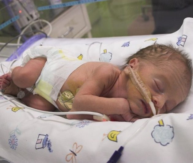 Пневмония после ИВЛ у новорожденного