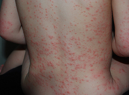 Аллергическая сыпь