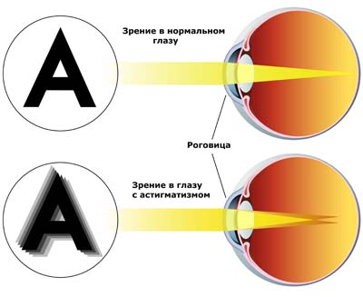 Астигматизм