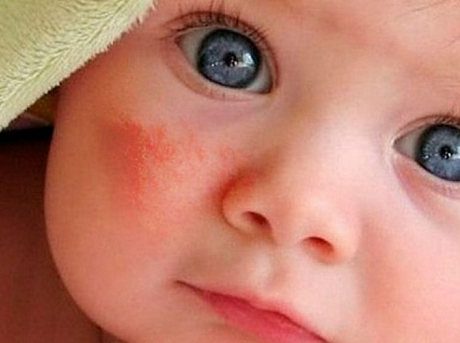 Аллергические реакции