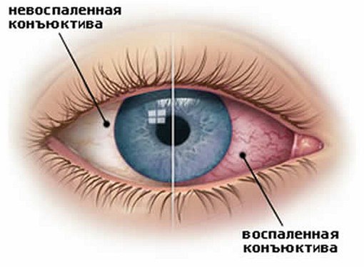 Вирусный конъюнктивит