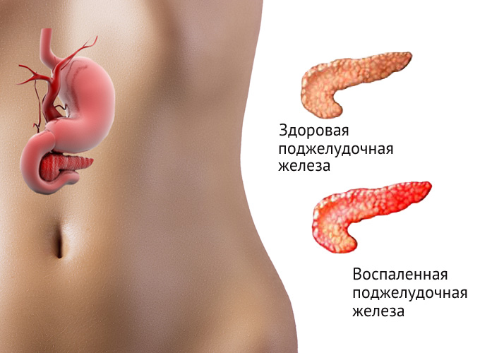 Воспаление поджелудочной железы