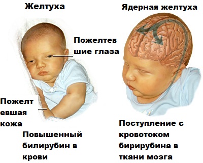 Ядерная желтуха