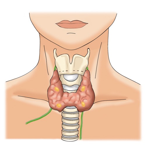 Гипертиреоз