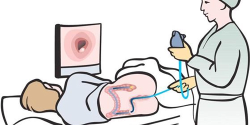 колоноскопия