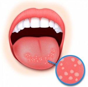 кандидоз языка