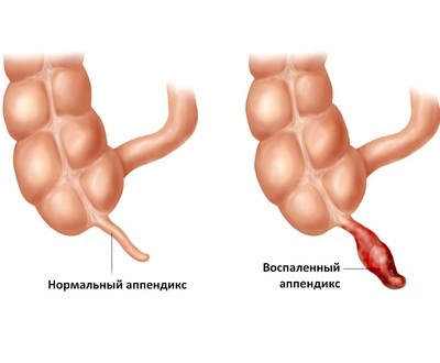 аппендицит