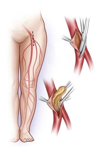 Облитерирующий атеросклероз нижних конечностей атеросклероз нижних конечностей