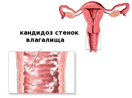вульвовагинальный кандидоз