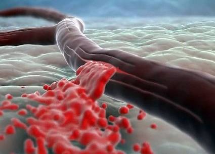 кровотечение из вены