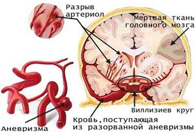 Влияние алкоголя на мозг