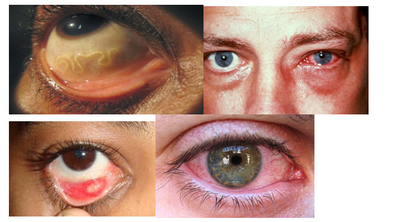 глаза при паразитах