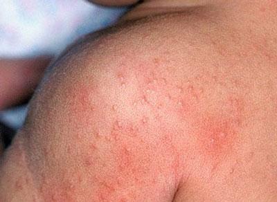 Аллергия на морскую воду