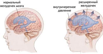 Повышенное внутричерепное давление