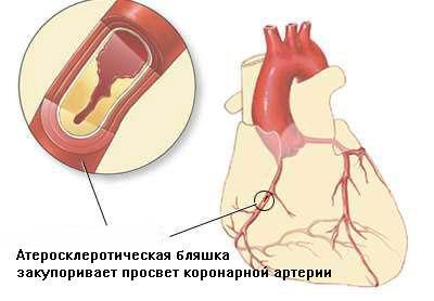 Ишемическая болезнь сердца