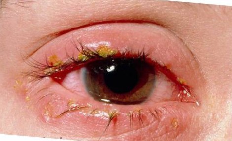 как выглядит демодекоз