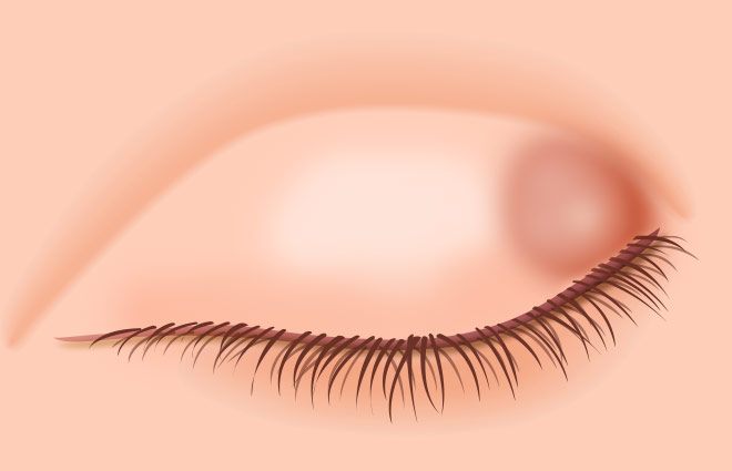 века при халязионе