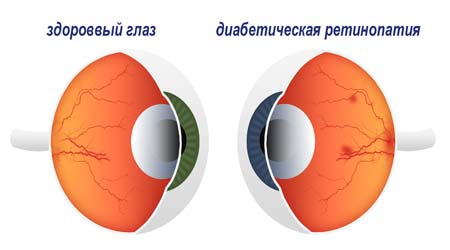 ретинопатия причины