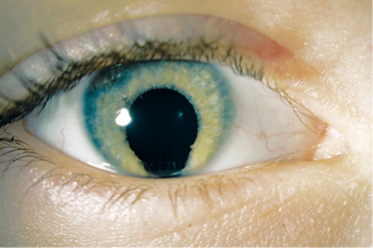 болезнь радужки