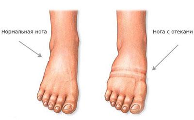 Отек ног