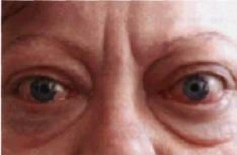 причины выпученных глаз