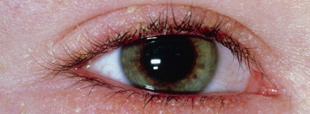 чашуйчатый блефарит