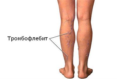 Проявление тромбофлебита