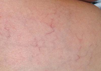 Лопнувшие капилляры