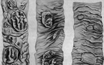 Поражение кишечника при тифе