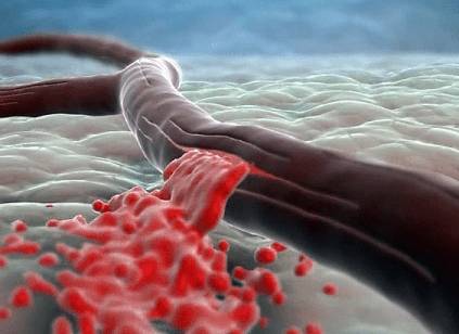 Внутреннее кровотечение