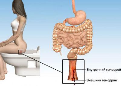 Виды геморроя