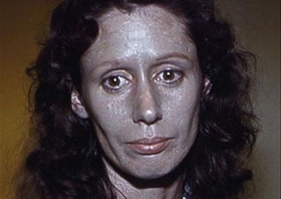 Цвет кожи при аргирозе