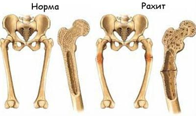 Проявление рахита