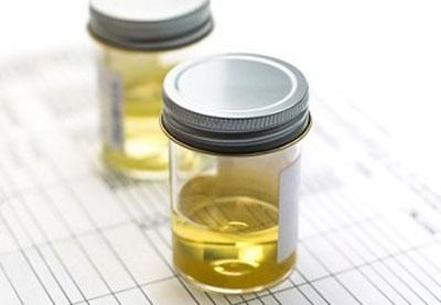 Анализ мочи