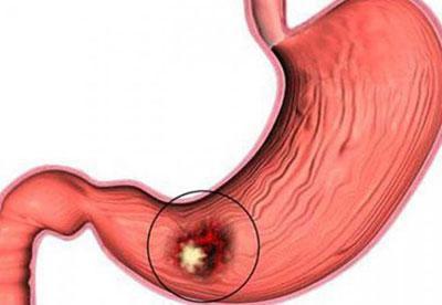 Язва желудка