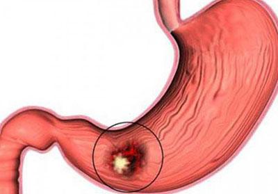 Язва желудка