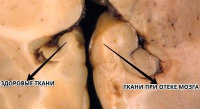 Ткани при отеке головного мозга
