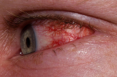 признаки красных глаз