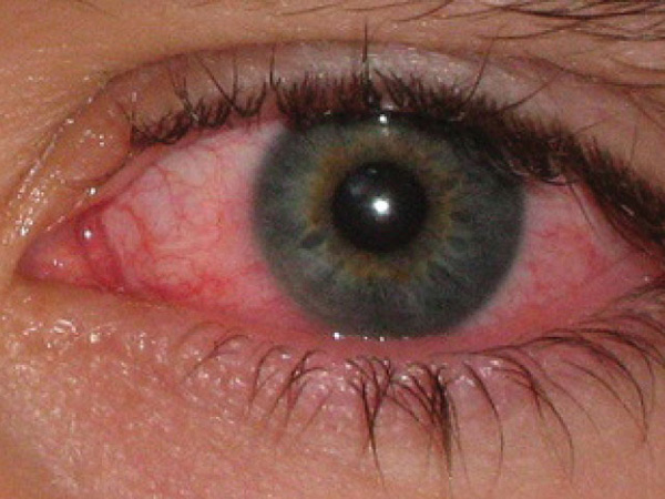 воспаленый глаз