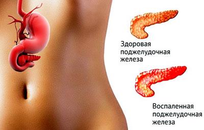 Воспаление поджелудочной железы