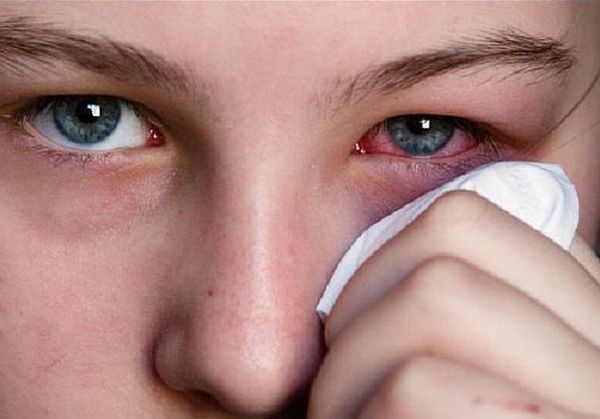 слезотечение и краснота глаз