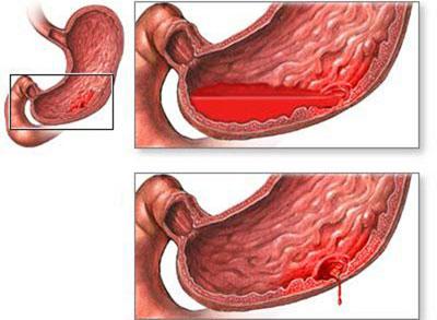 Прободнение желудка