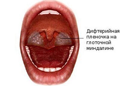 Проявление дифтерии